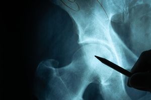 肋骨断了几根可以定残